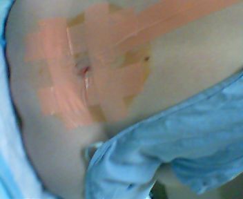 Epidural Catheder (?1 mm width ?)